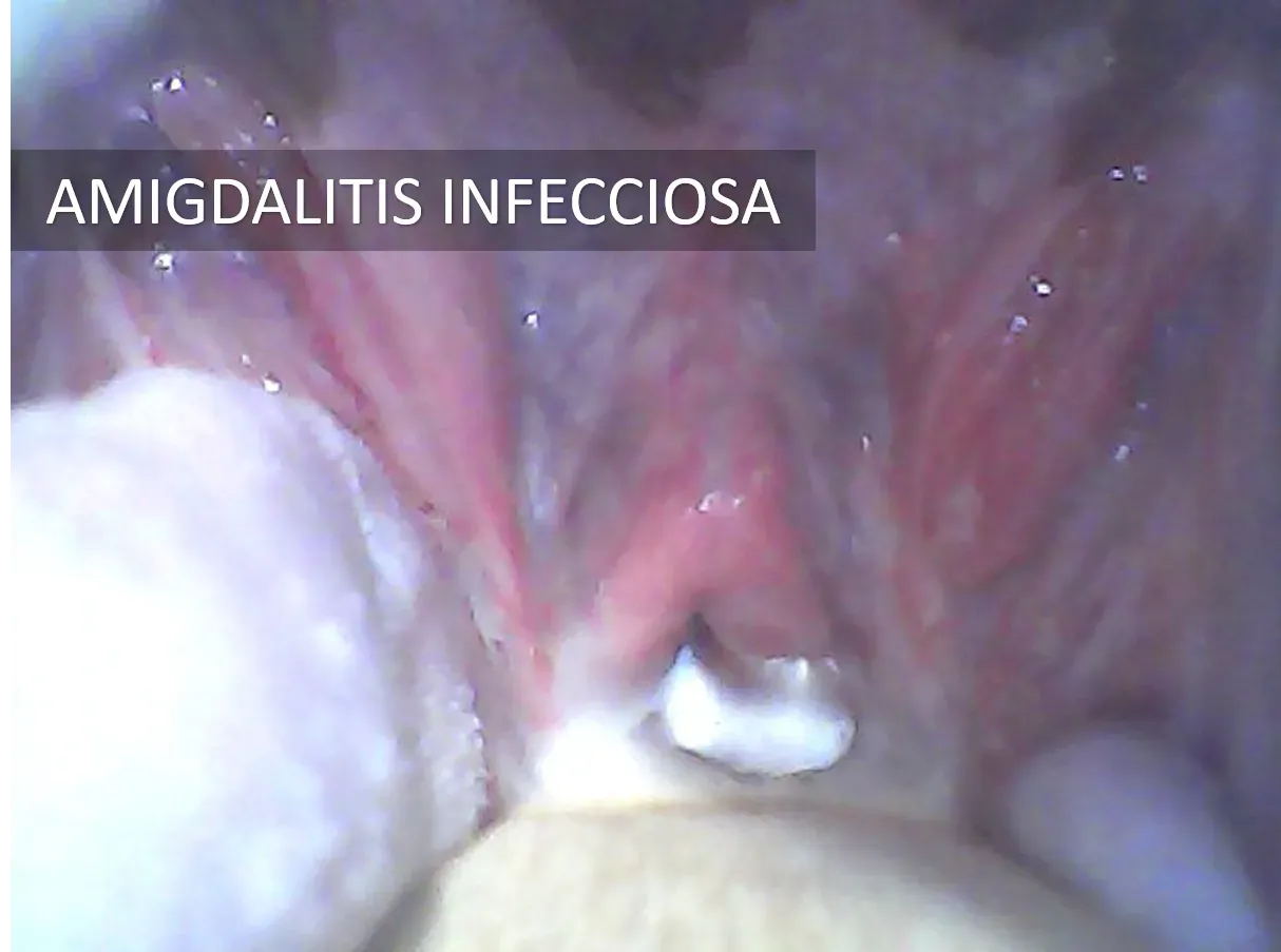 Otorrinolaringología